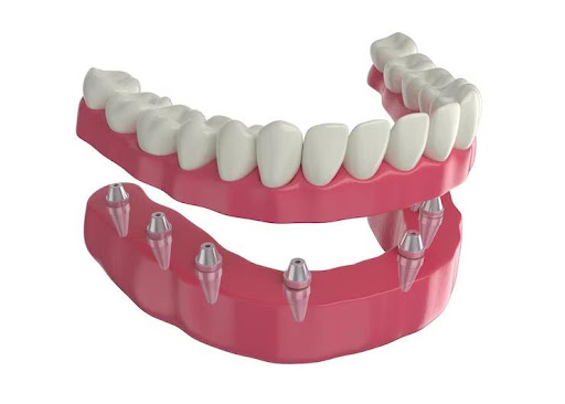 How Long Will Your Dental Crowns Last? Understanding Their Durability