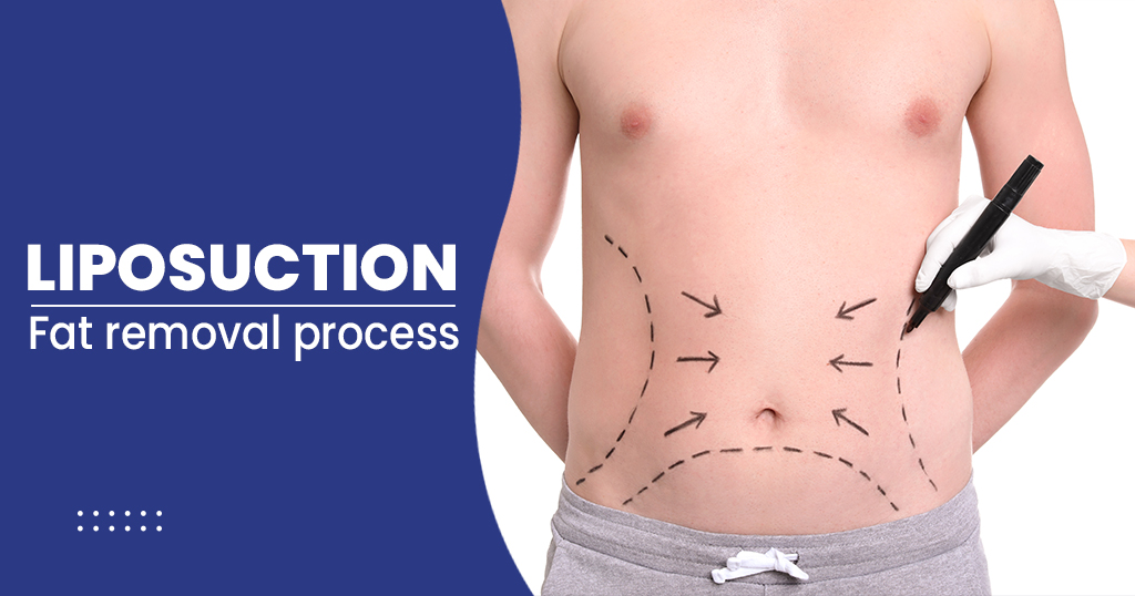 The Cost of Liposuction in Austin: What You Need to Know