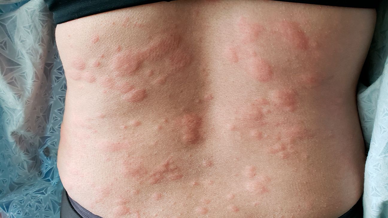 Common Causes of Rashes and How to Alleviate Them