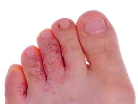 How to Identify Athlete’s Foot: Signs, Symptoms, and Solutions