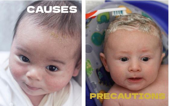 Common Causes of Cradle Cap in Babies And What Are The Safety Precautions