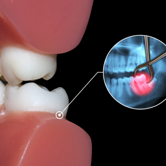 Can you Drink Alcohol After Wisdom Tooth Extraction