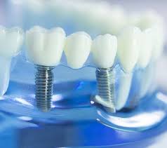 Enhance Your Oral Health with Dental Implants in Rockville, MD