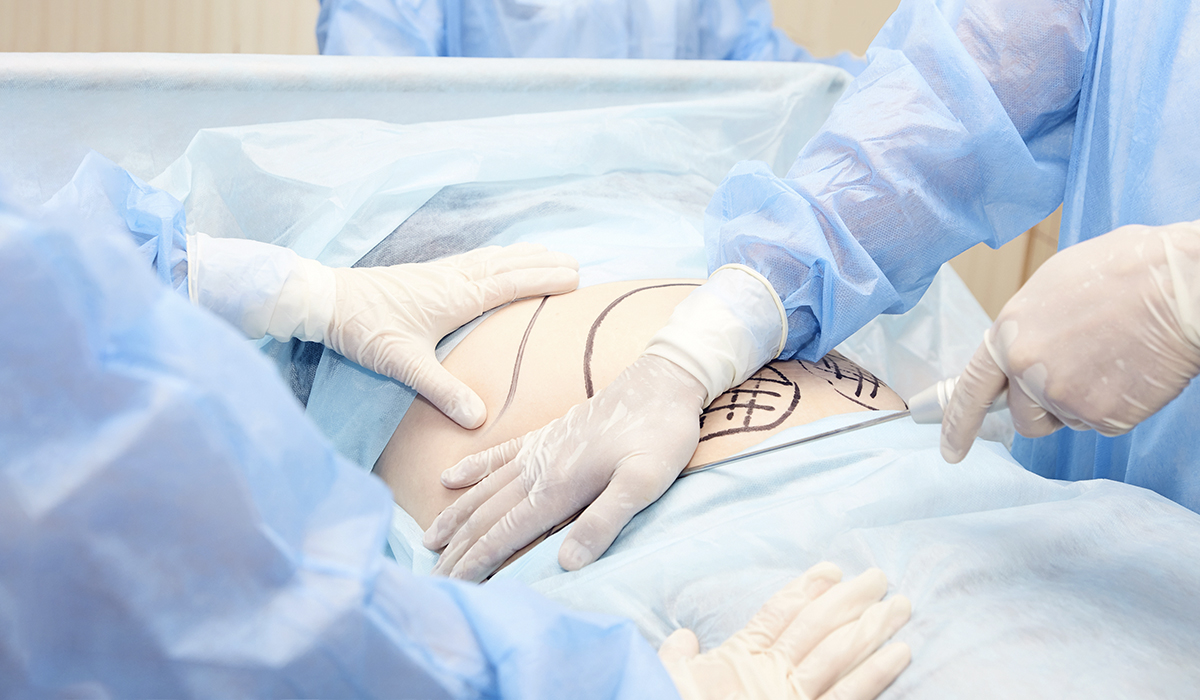 Liposuction Surgery: What You Need to Know - Husband Info